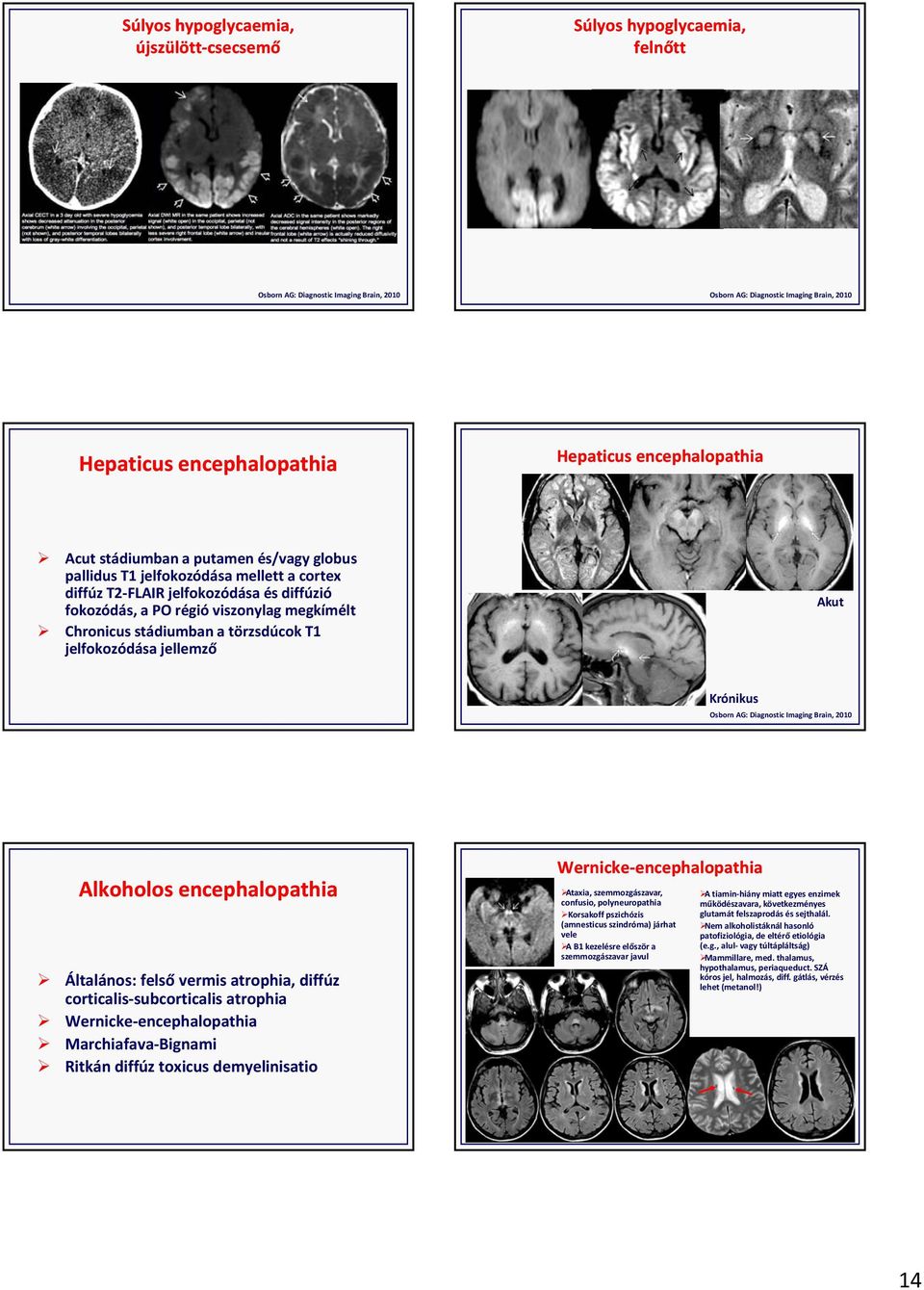stádiumban a törzsdúcok T1 jelfokozódása jellemző Akut Krónikus Osborn AG: Diagnostic Imaging Brain, 2010 Alkoholos encephalopathia Általános: felső vermis atrophia, diffúz corticalis subcorticalis