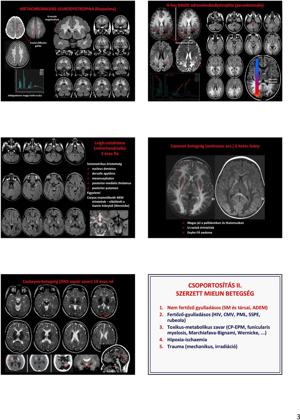 ) 6 hetes leány Szimmetrikus érintettség nucleus dentatus dorsalis agytörzs mesencephalon posterior medialis thalamus posterior putamen Figyelem!