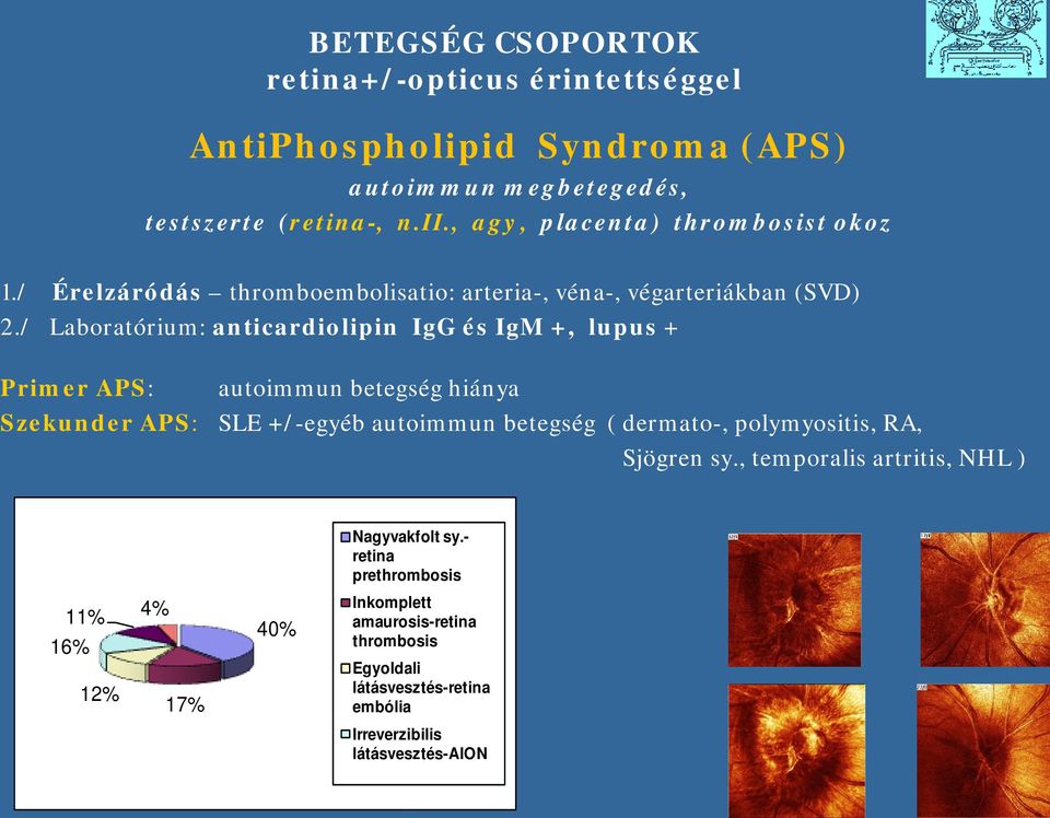 / Labratórium: anticardilipin IgG és IgM +, lupus + Primer APS: Szekunder APS: autimmun betegség hiánya SLE +/-egyéb autimmun betegség ( dermat-,