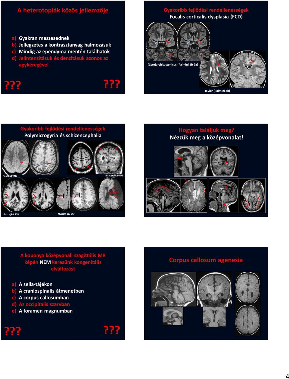 Bilateralis PMG Fokális PMG Nyitott ajú SCH Zárt ajkú SCH A koponya középvonali szagittális MR képén NEM keresünk kongenitális elváltozást a) b) c) d) e)