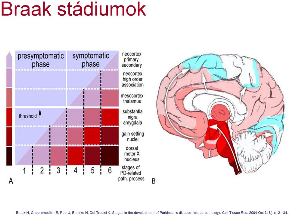 Stages in the development of Parkinson's