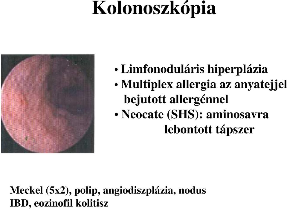 (SHS): aminosavra lebontott tápszer Meckel (5x2),