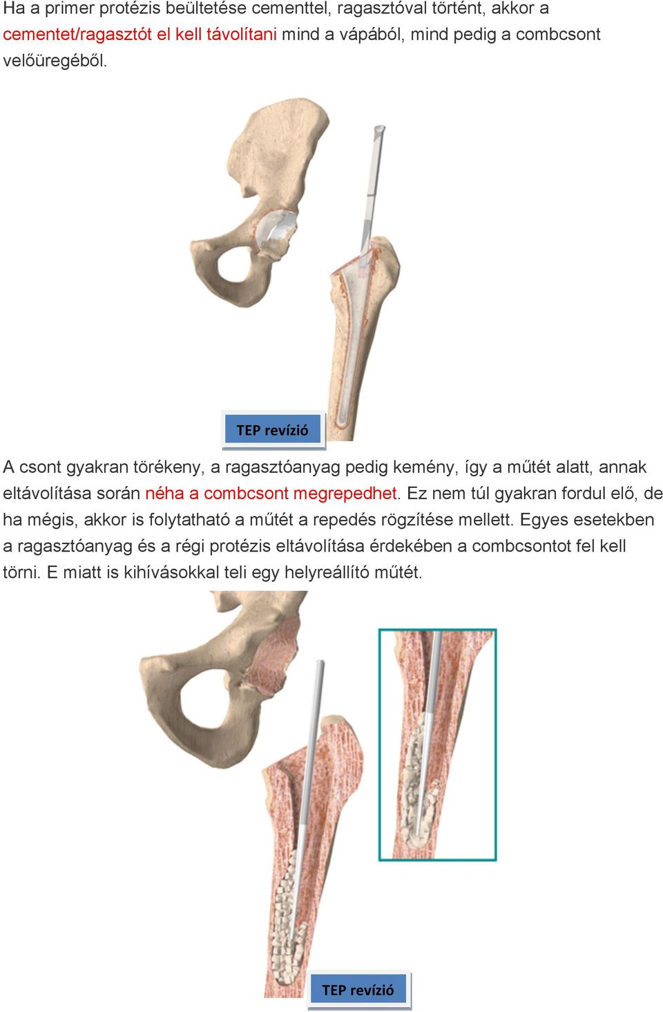 TEP revízió A csont gyakran törékeny, a ragasztóanyag pedig kemény, így a műtét alatt, annak eltávolítása során néha a combcsont megrepedhet.