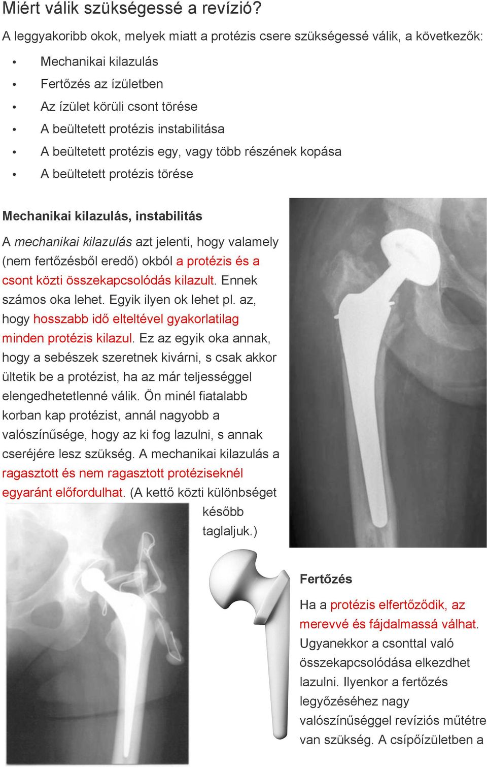 beültetett protézis egy, vagy több részének kopása A beültetett protézis törése Mechanikai kilazulás, instabilitás A mechanikai kilazulás azt jelenti, hogy valamely (nem fertőzésből eredő) okból a