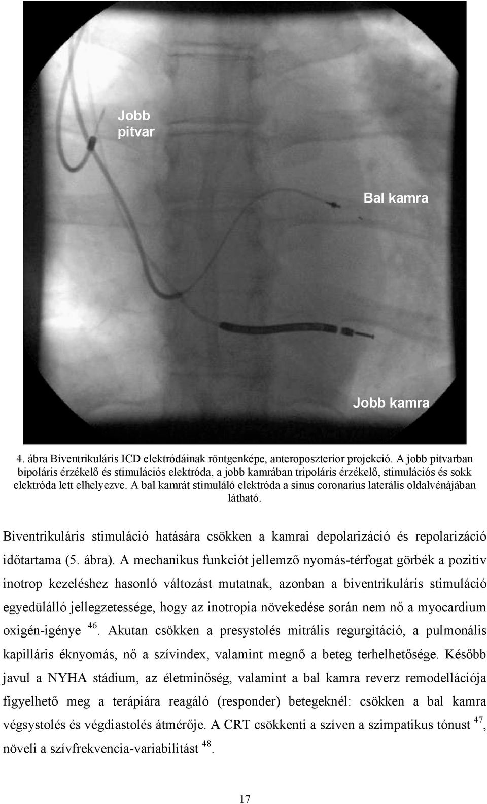 A bal kamrát stimuláló elektróda a sinus coronarius laterális oldalvénájában látható. Biventrikuláris stimuláció hatására csökken a kamrai depolarizáció és repolarizáció idıtartama (5. ábra).