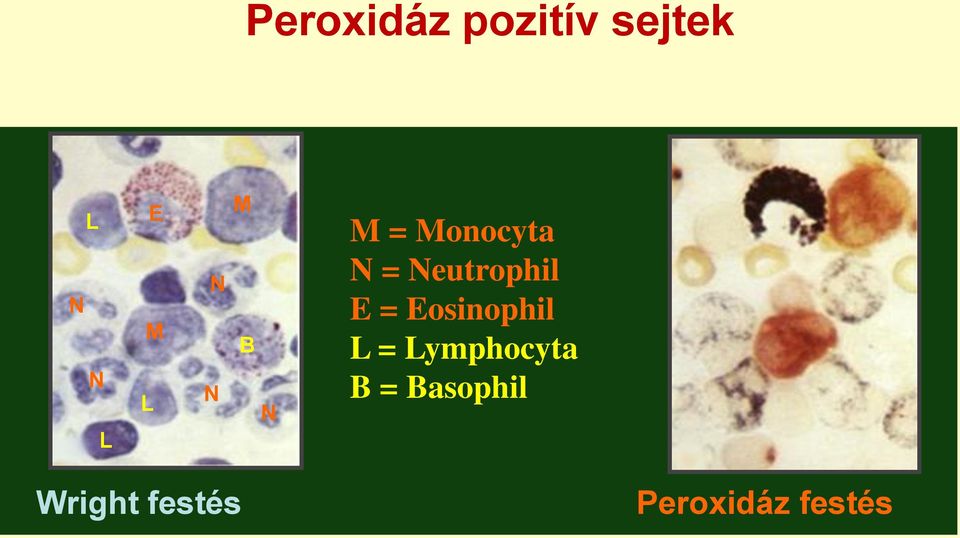 Neutrophil E = Eosinophil L =