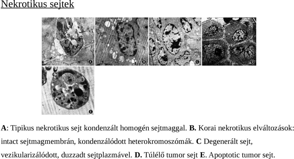 Korai nekrotikus elváltozások: intact sejtmagmembrán, kondenzálódott