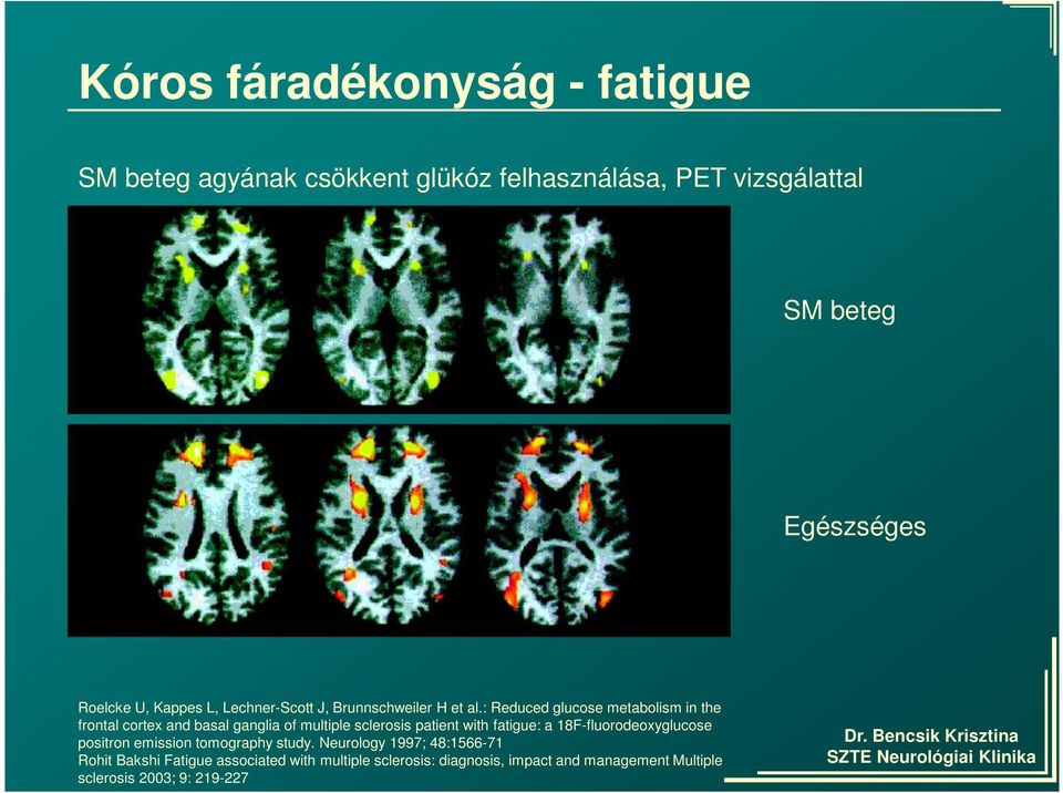 : Reduced glucose metabolism in the frontal cortex and basal ganglia of multiple sclerosis patient with fatigue: a