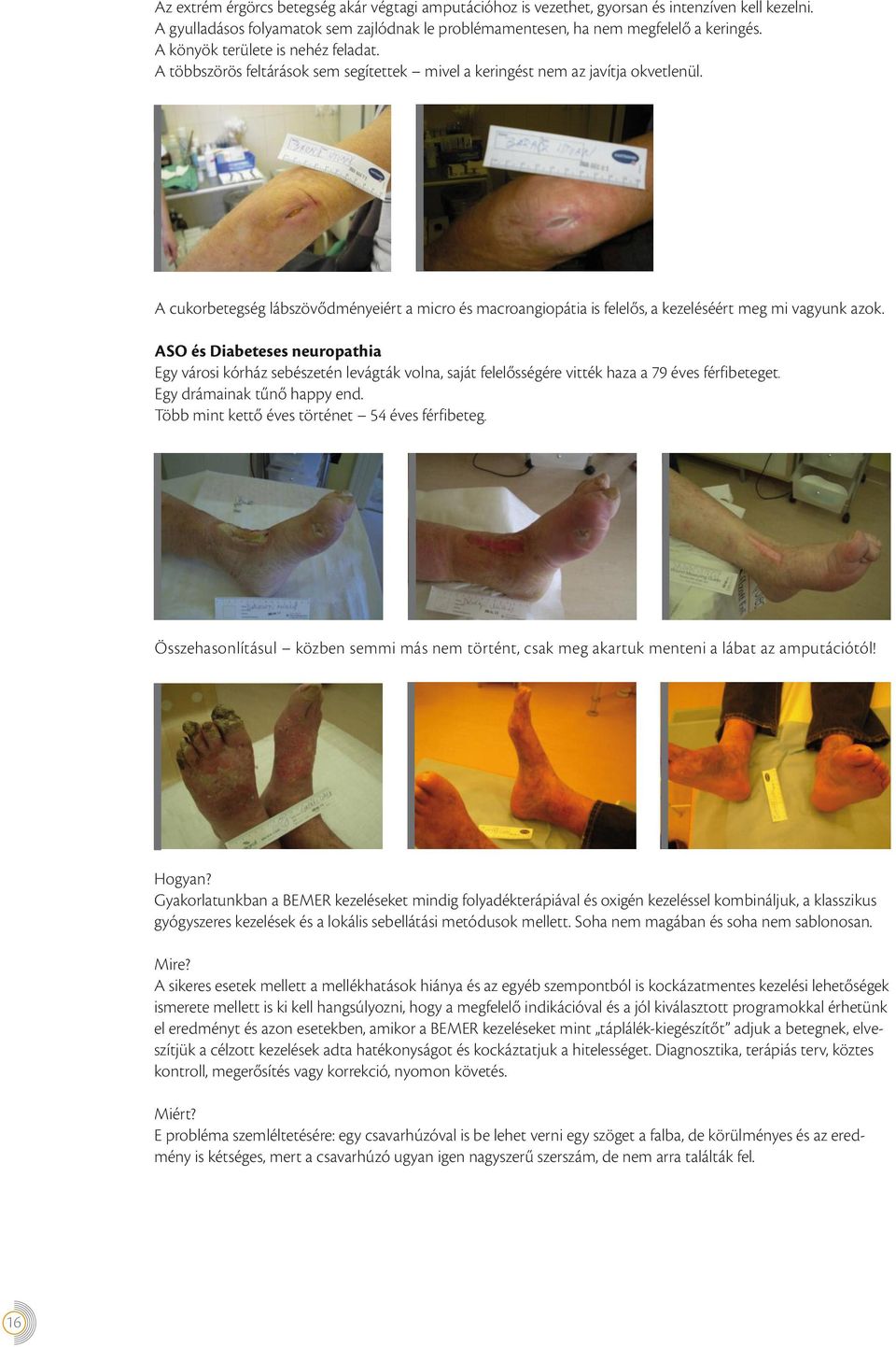 A cukorbetegség lábszövődményeiért a micro és macroangiopátia is felelős, a kezeléséért meg mi vagyunk azok.