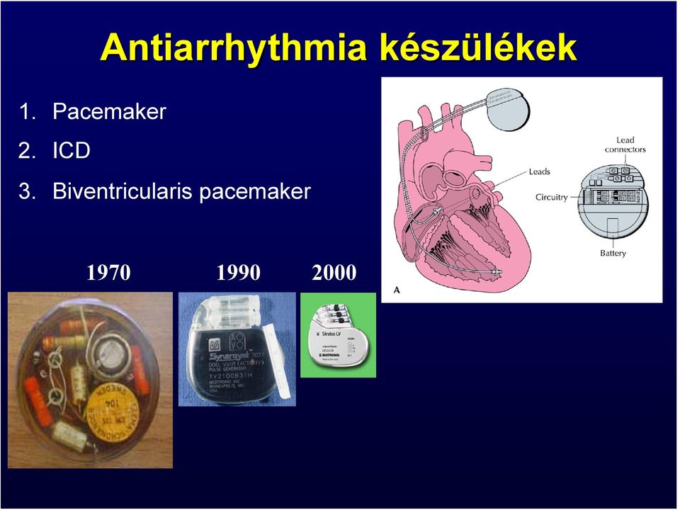 Pacemaker 2. ICD 3.