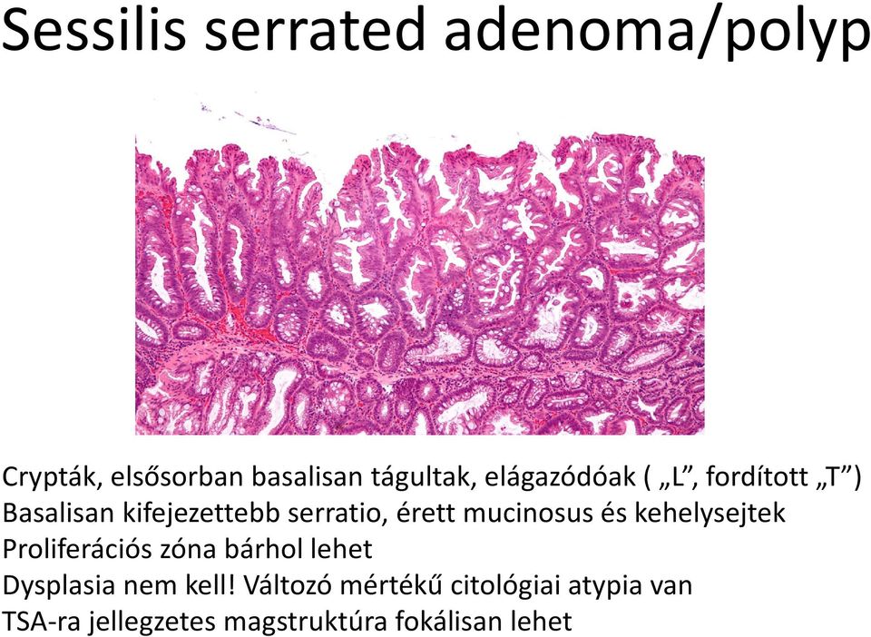 mucinosus és kehelysejtek Proliferációs zóna bárhol lehet Dysplasia nem kell!