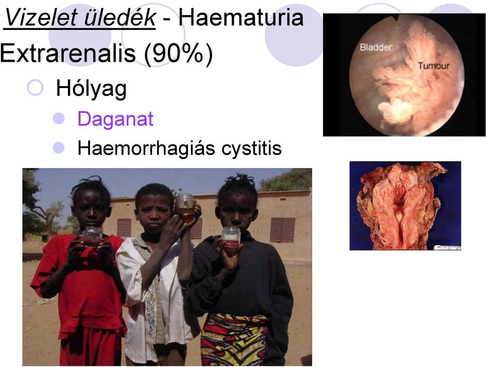 cystitis Prostata hypertrophia