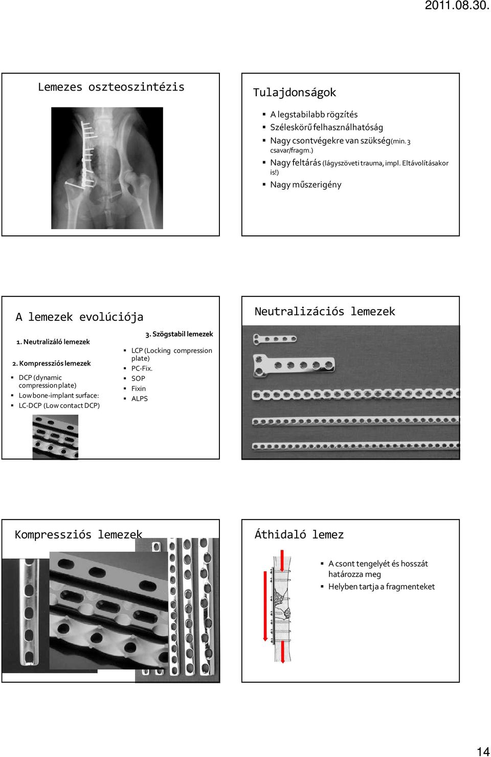 Neutralizáló lemezek 2. Kompressziós lemezek DCP (dynamic compressionplate) Lowbone-implant surface: LC-DCP (Low contact DCP) 3.