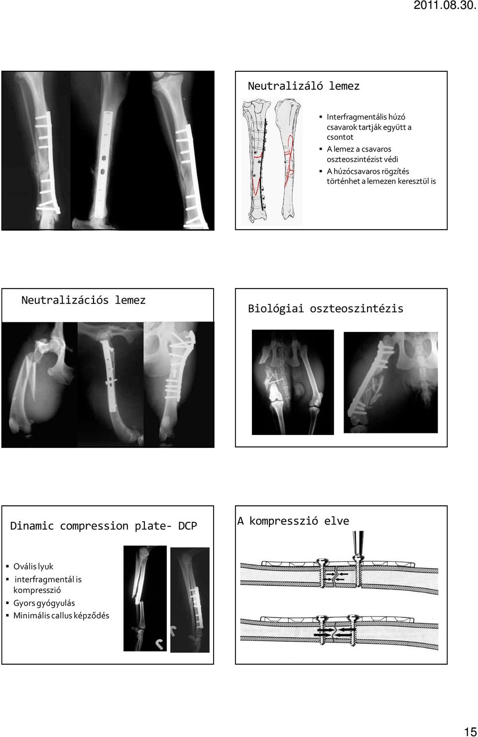 Neutralizációs lemez Biológiai oszteoszintézis dr.diószegi Zoltán ÁOTE Seb.