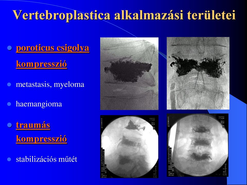 kompresszió metastasis, myeloma