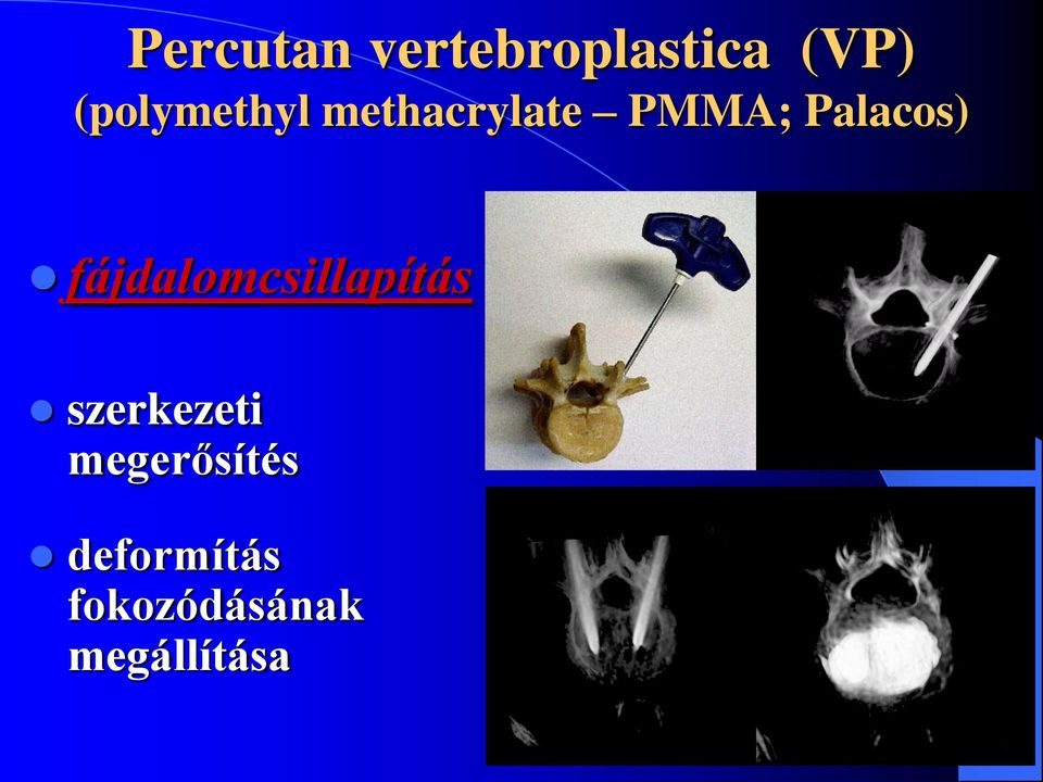 Palacos) fájdalomcsillapítás