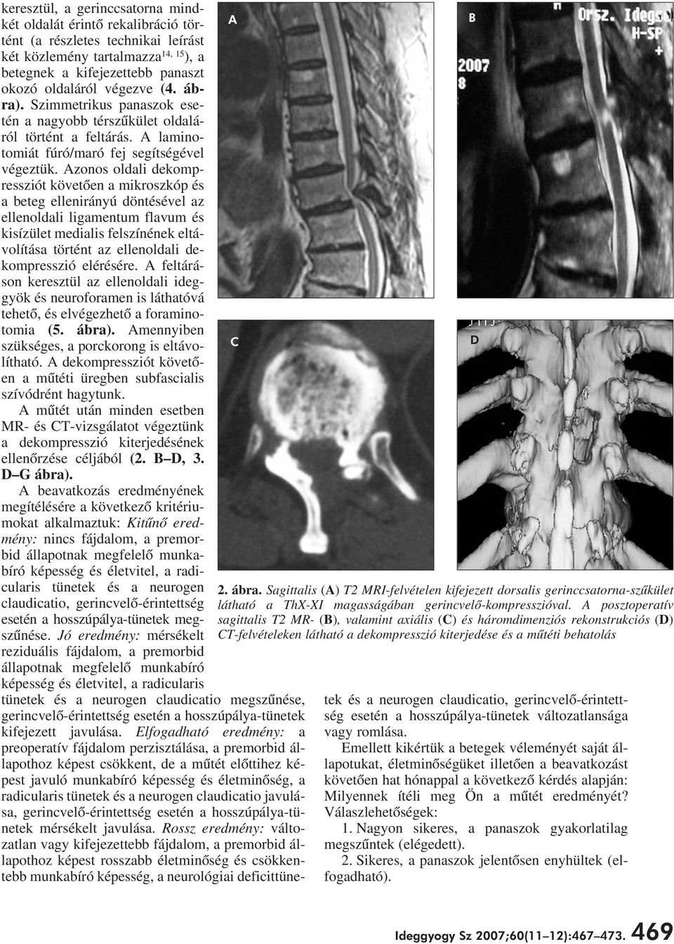 Azonos oldali dekompressziót követôen a mikroszkóp és a beteg ellenirányú döntésével az ellenoldali ligamentum flavum és kisízület medialis felszínének eltávolítása történt az ellenoldali