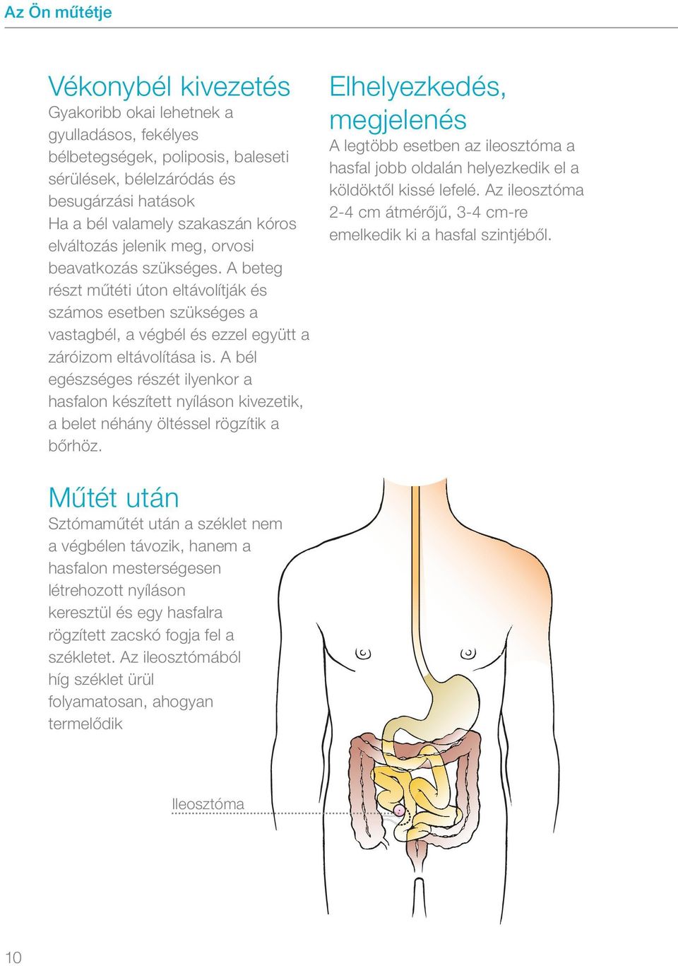 Tudnivalók kórházi ellátás előtt és után. Mindennapi élet sztómával - PDF  Free Download