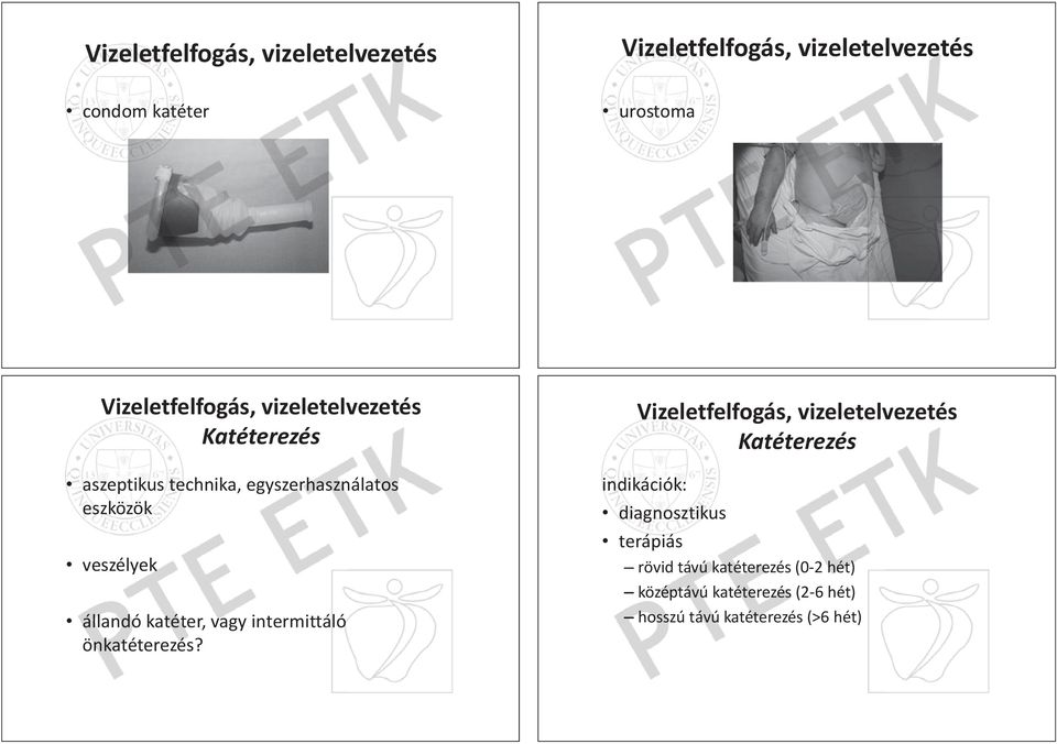 állandó katéter, vagy intermittáló önkatéterezés?