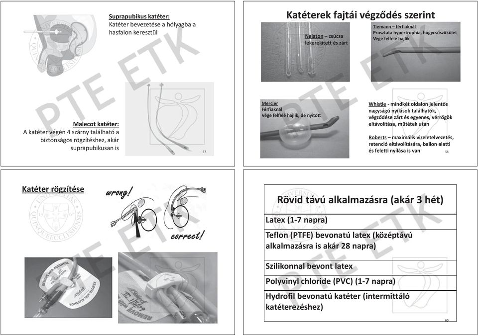 található a biztonságos rögzítéshez, akár suprapubikusan is Tiemann férfiaknál Prosztata hypertrophia, hypert rtro rophia ro ia, hú ia húgycsƅszƾkület Vége felfelé hajlik lé h haj ajlililikk aj