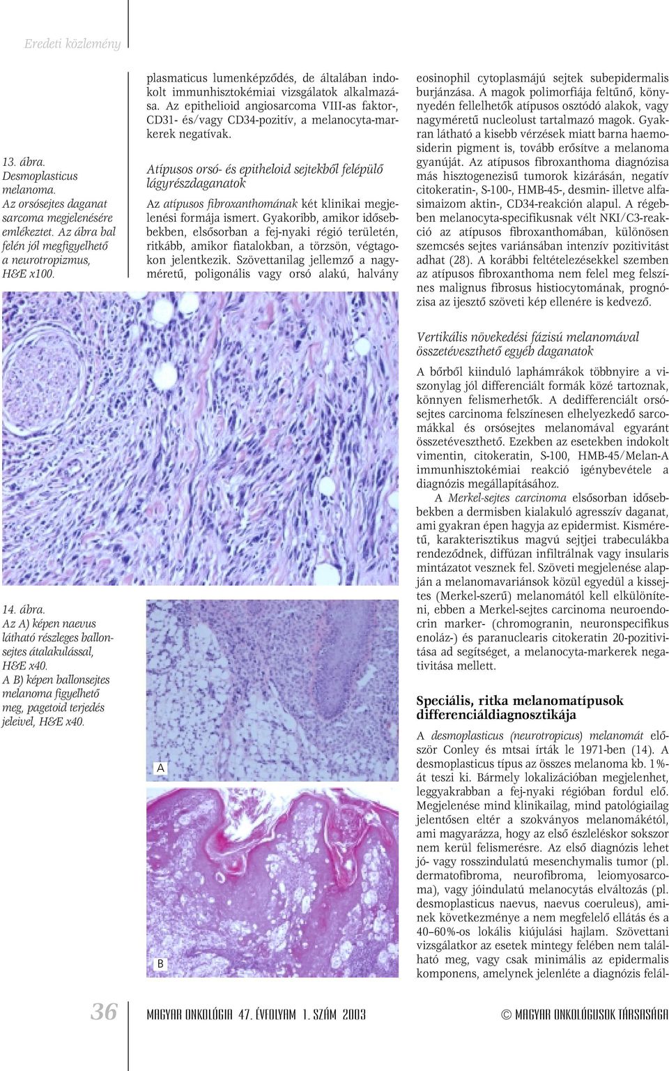 Az epithelioid angiosarcoma VIII-as faktor-, CD31- és/vagy CD34-pozitív, a melanocyta-markerek negatívak.