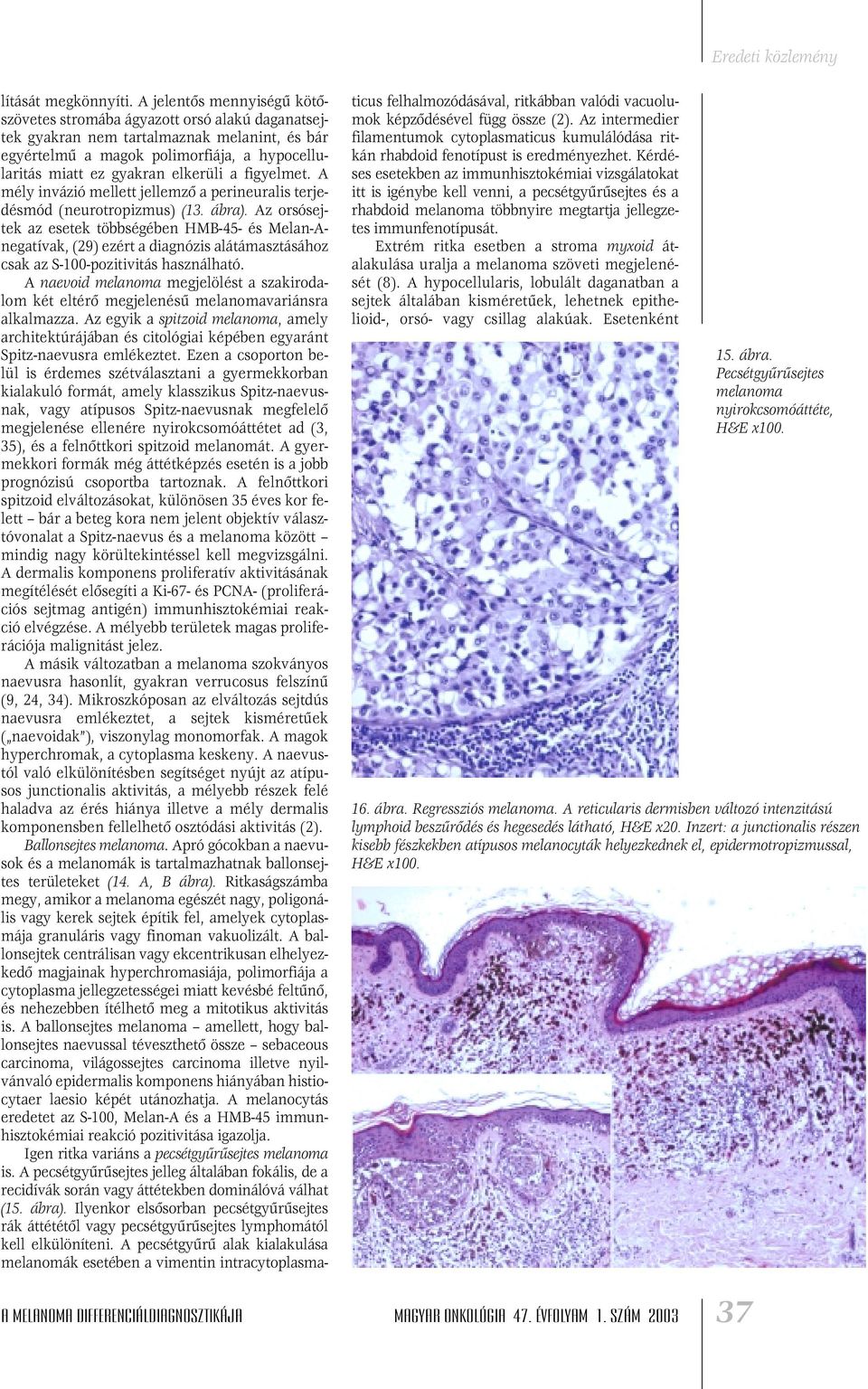 figyelmet. A mély invázió mellett jellemzô a perineuralis terjedésmód (neurotropizmus) (13. ábra).