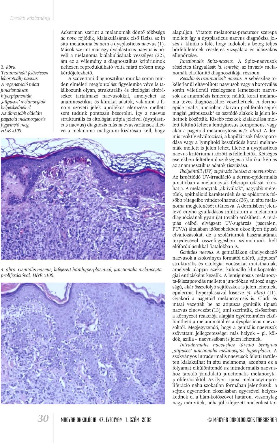 (1). Mások szerint már egy dysplasticus naevus is növeli a melanoma kialakulásának veszélyét (32), ám ez a vélemény a diagnosztikus kritériumok nehezen reprodukálható volta miatt erôsen