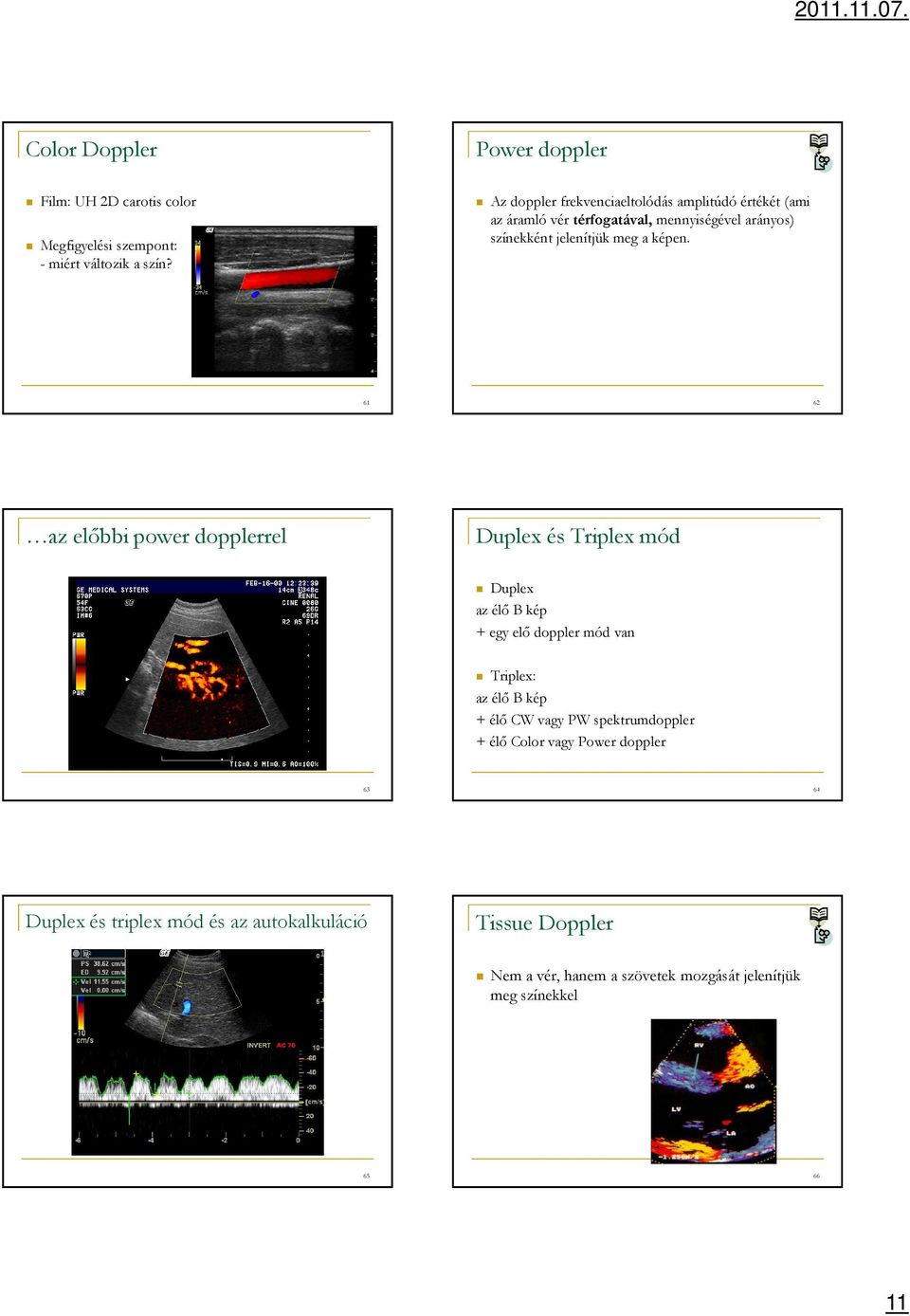 61 62 az előbbi power dopplerrel Duplex és Triplex mód Duplex az élő B kép + egy elő doppler mód van Triplex: az élő B kép + élő CW vagy PW