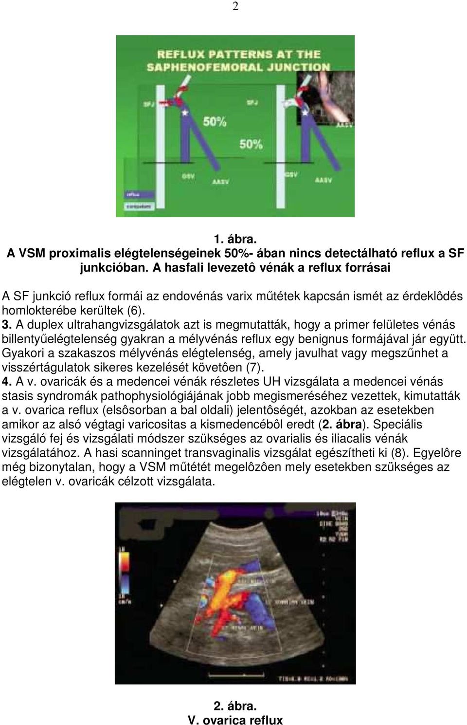 A duplex ultrahangvizsgálatok azt is megmutatták, hogy a primer felületes vénás billentyőelégtelenség gyakran a mélyvénás reflux egy benignus formájával jár együtt.
