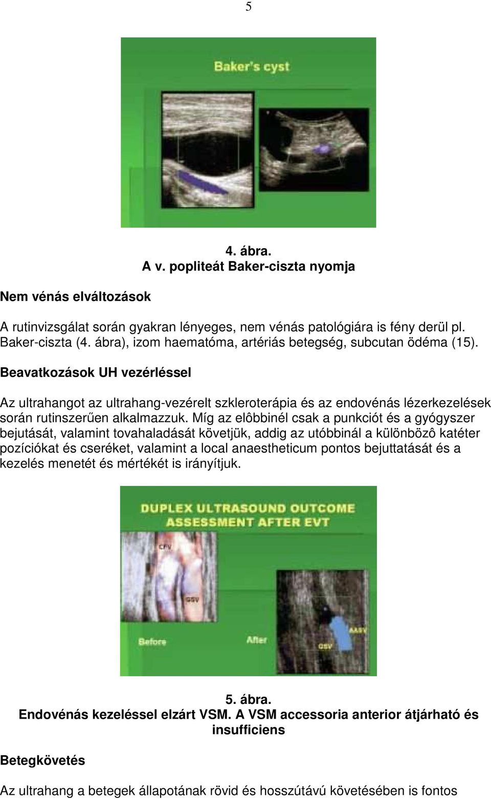 Beavatkozások UH vezérléssel Az ultrahangot az ultrahang-vezérelt szkleroterápia és az endovénás lézerkezelések során rutinszerően alkalmazzuk.