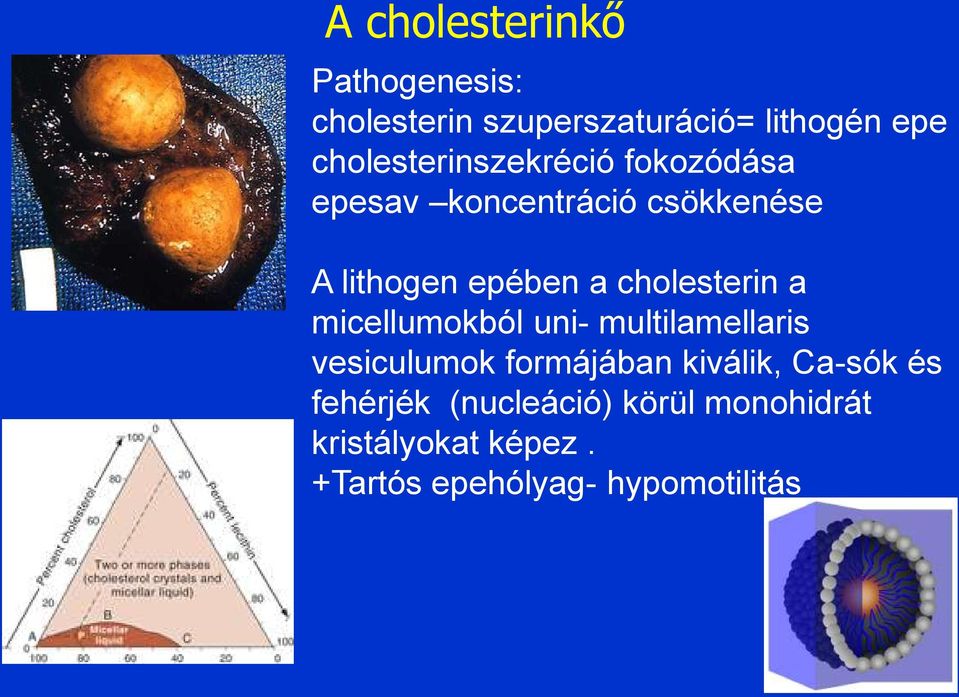 cholesterin a micellumokból uni- multilamellaris vesiculumok formájában kiválik,