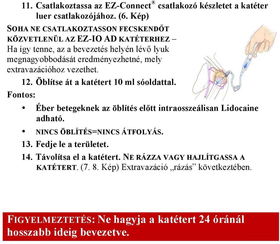 extravazációhoz vezethet. 12. Öblítse át a katétert 10 ml sóoldattal. Fontos: Éber betegeknek az öblítés előtt intraosszeálisan Lidocaine adható.