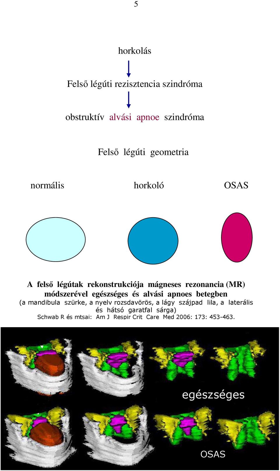 egészséges és alvási apnoes betegben (a mandibula szürke, a nyelv rozsdavörös, a lágy szájpad lila, a