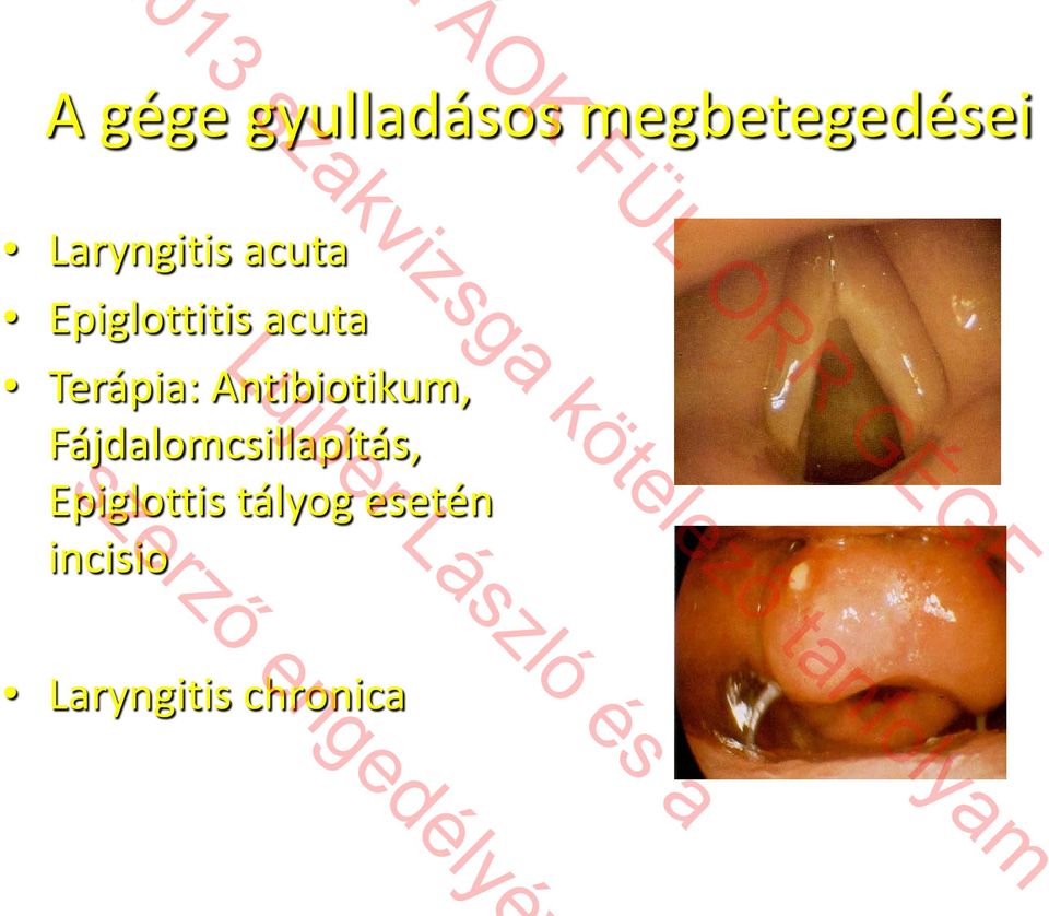 Epiglottitis acuta Terápia: Antibiotikum,