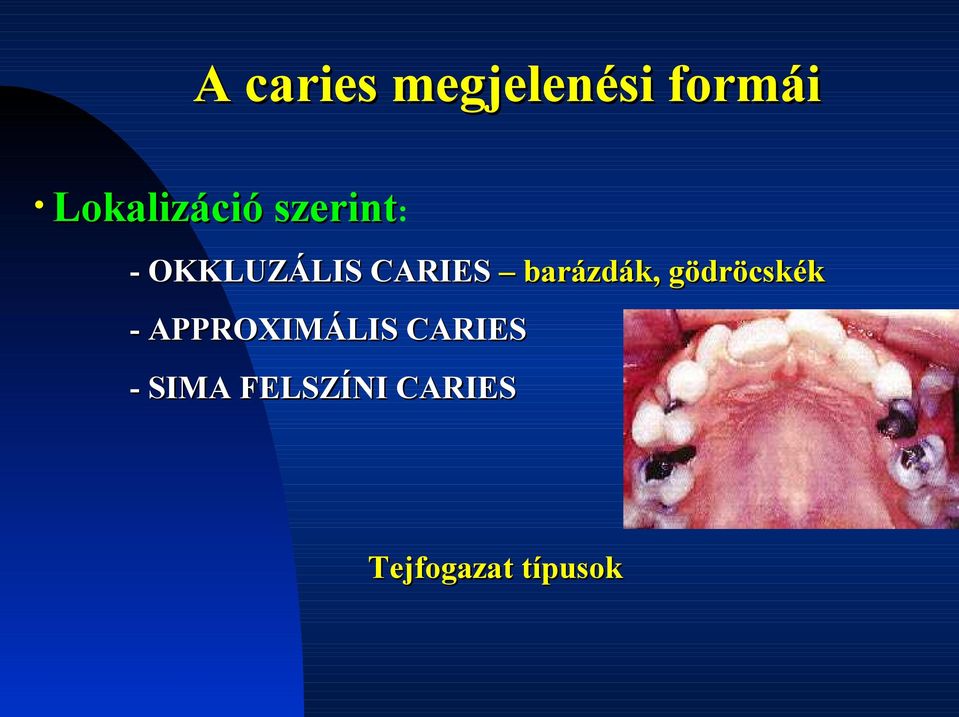 CARIES barázdák, gödröcskék -