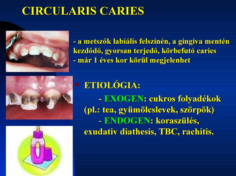 megjelenhet ETIOLÓGIA: - EXOGEN: : cukros folyadékok (pl.