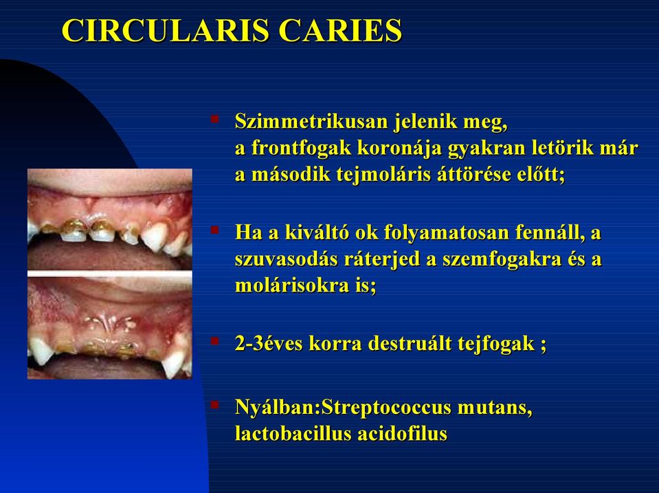 fennáll, a szuvasodás ráterjed a szemfogakra és a molárisokra is; 2-3éves