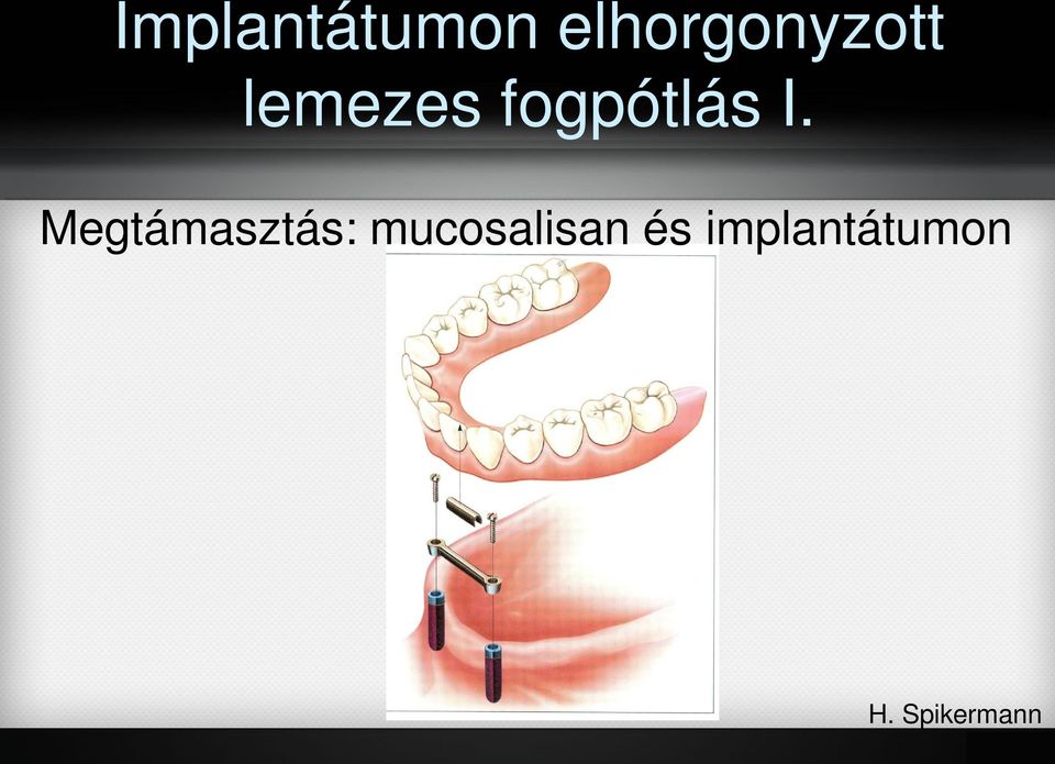 fogpótlás I.