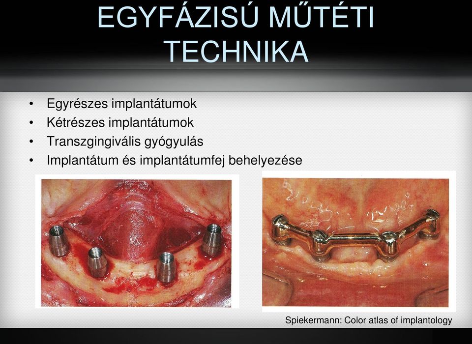 Transzgingivális gyógyulás Implantátum és