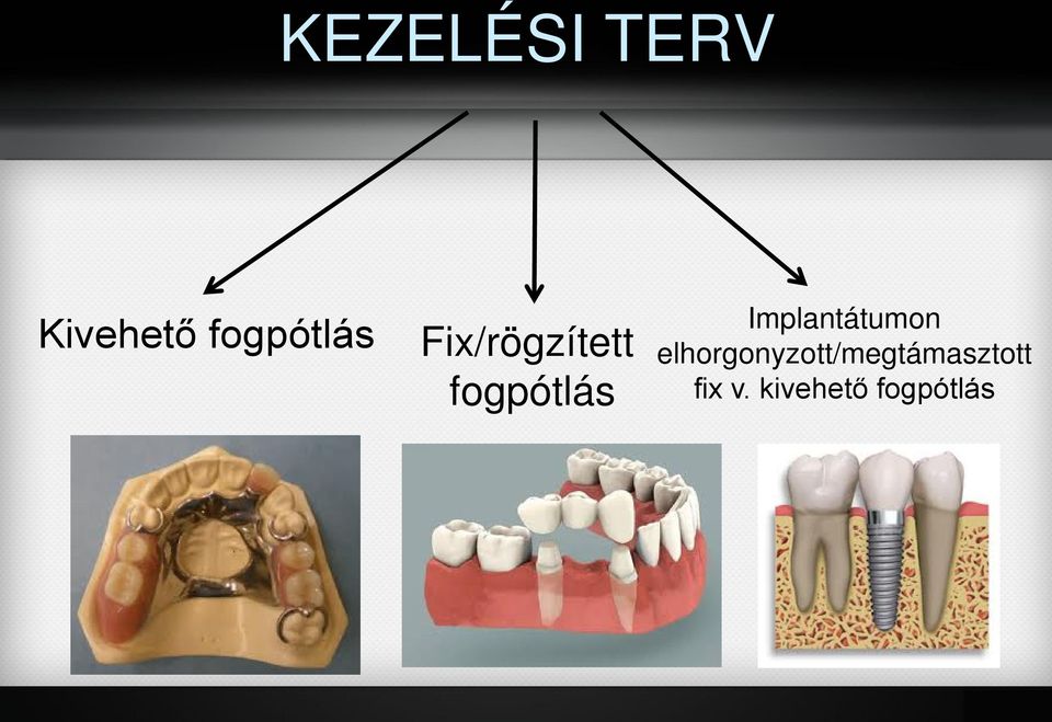 fogpótlás Implantátumon