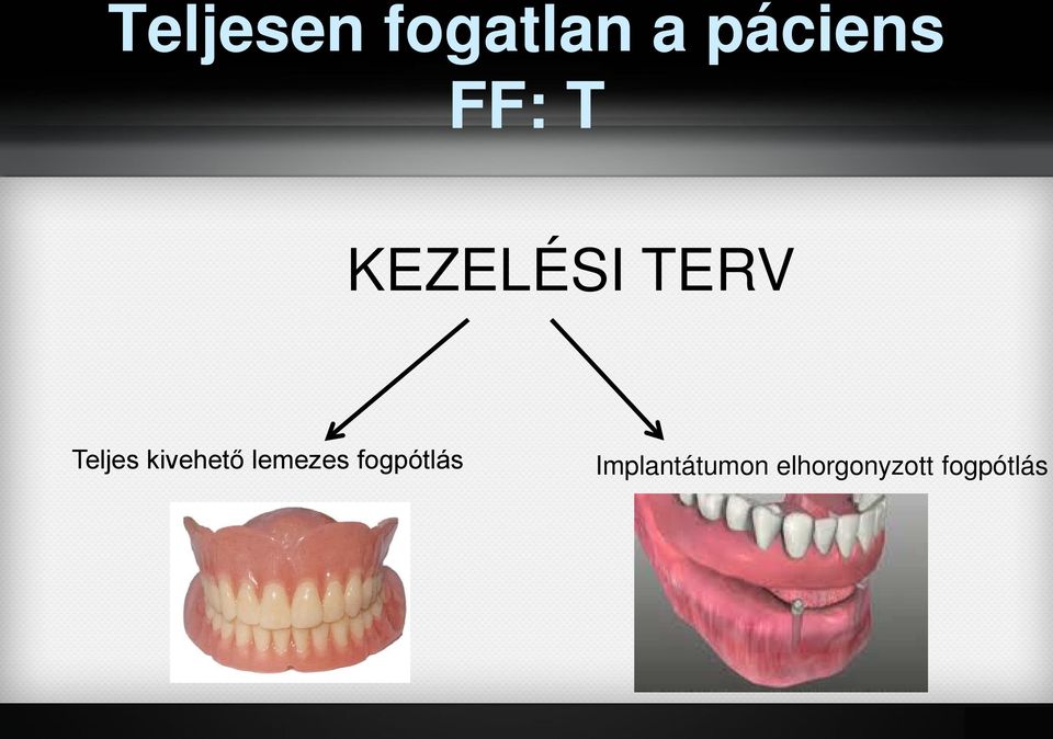 kivehető lemezes fogpótlás