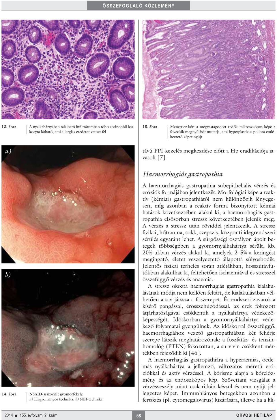 javasolt [7]. Haemorrhagiás gastropathia b) 14. ábra NSAID-asszociált gyomorfekély. a) Hagyományos technika.