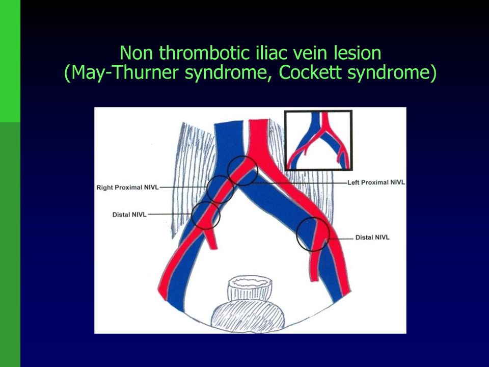 (May-Thurner