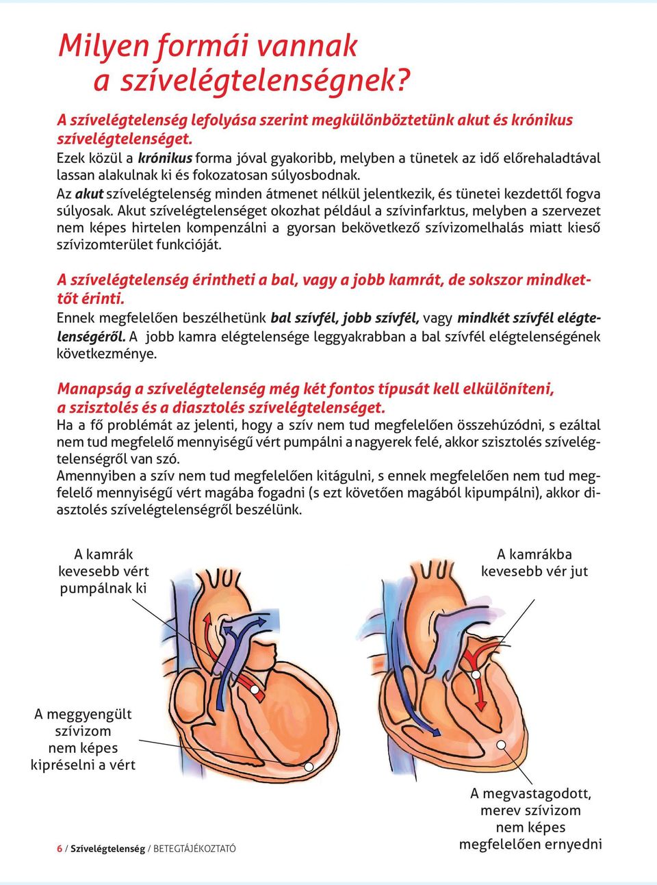 Az akut szívelégtelenség minden átmenet nélkül jelentkezik, és tünetei kezdettől fogva súlyosak.