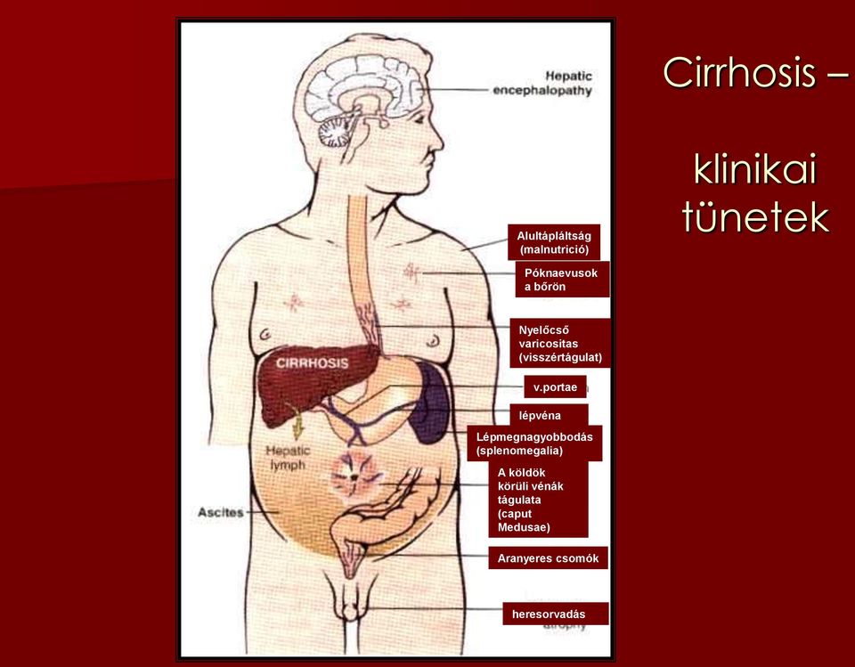 portae lépvéna Lépmegnagyobbodás (splenomegalia) A köldök