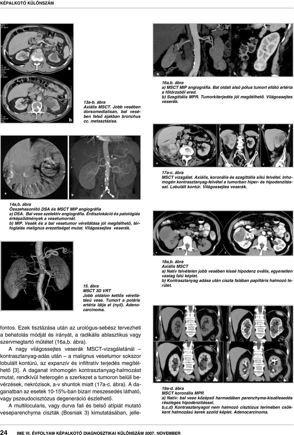 Inhomogén kontrasztanyag-felvétel a tumorban hiper- és hipodenzitással. Lobulált kontúr. Világossejtes veserák. 14a,b. ábra Összehasonlító DSA és MSCT MIP angiográfia a) DSA.