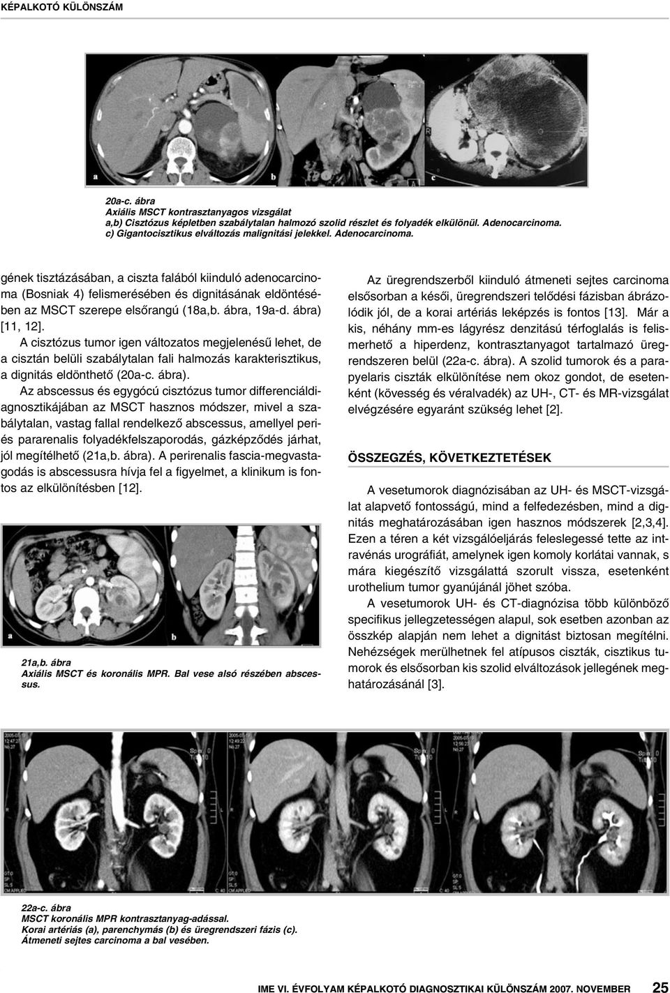 A cisztózus tumor igen változatos megjelenésû lehet, de a cisztán belüli szabálytalan fali halmozás karakterisztikus, a dignitás eldönthetô (20a-c. ábra).