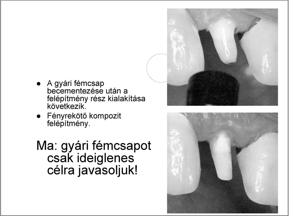Fényrekötő kompozit felépítmény.