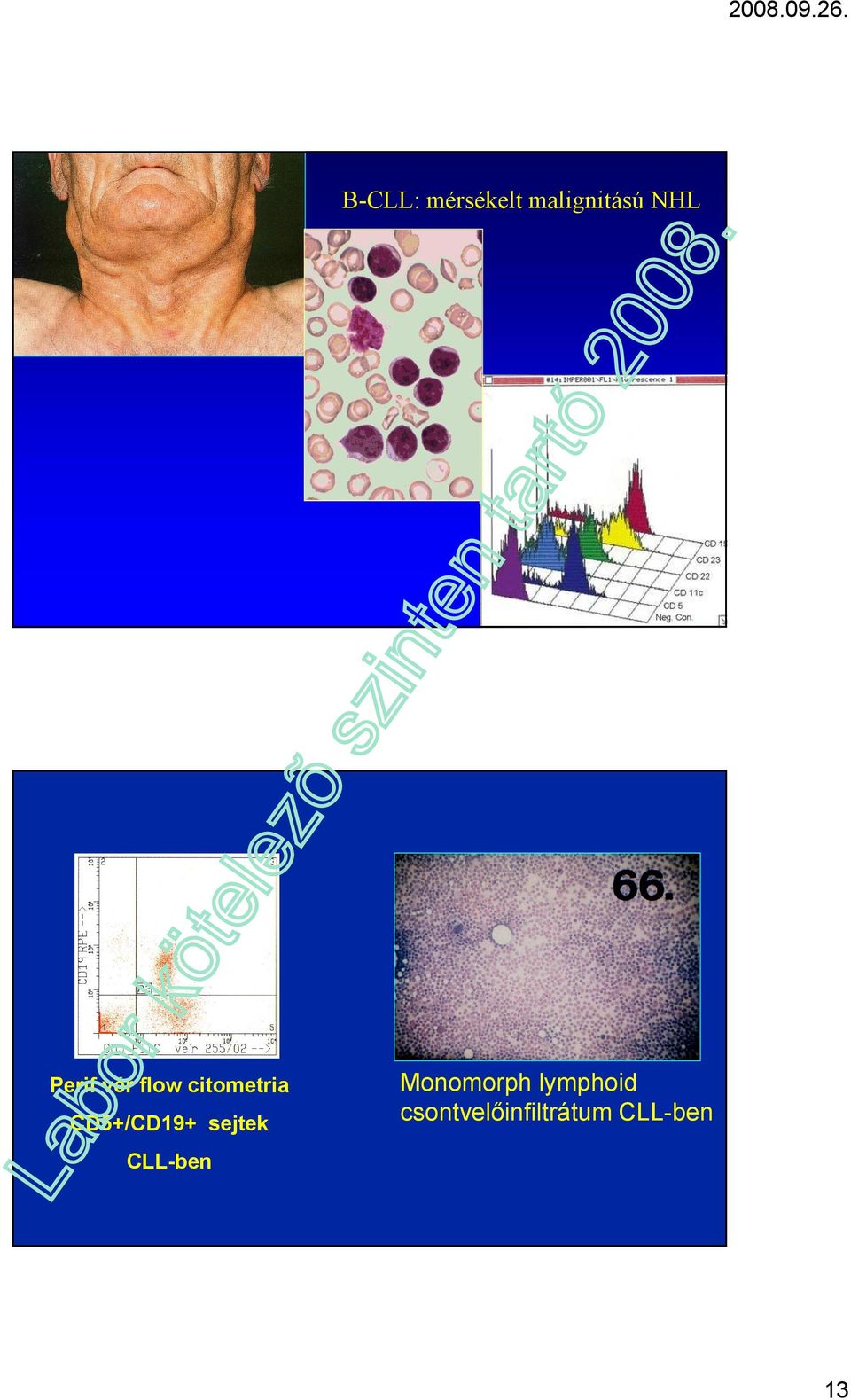 CD5+/CD19+ sejtek CLL-ben