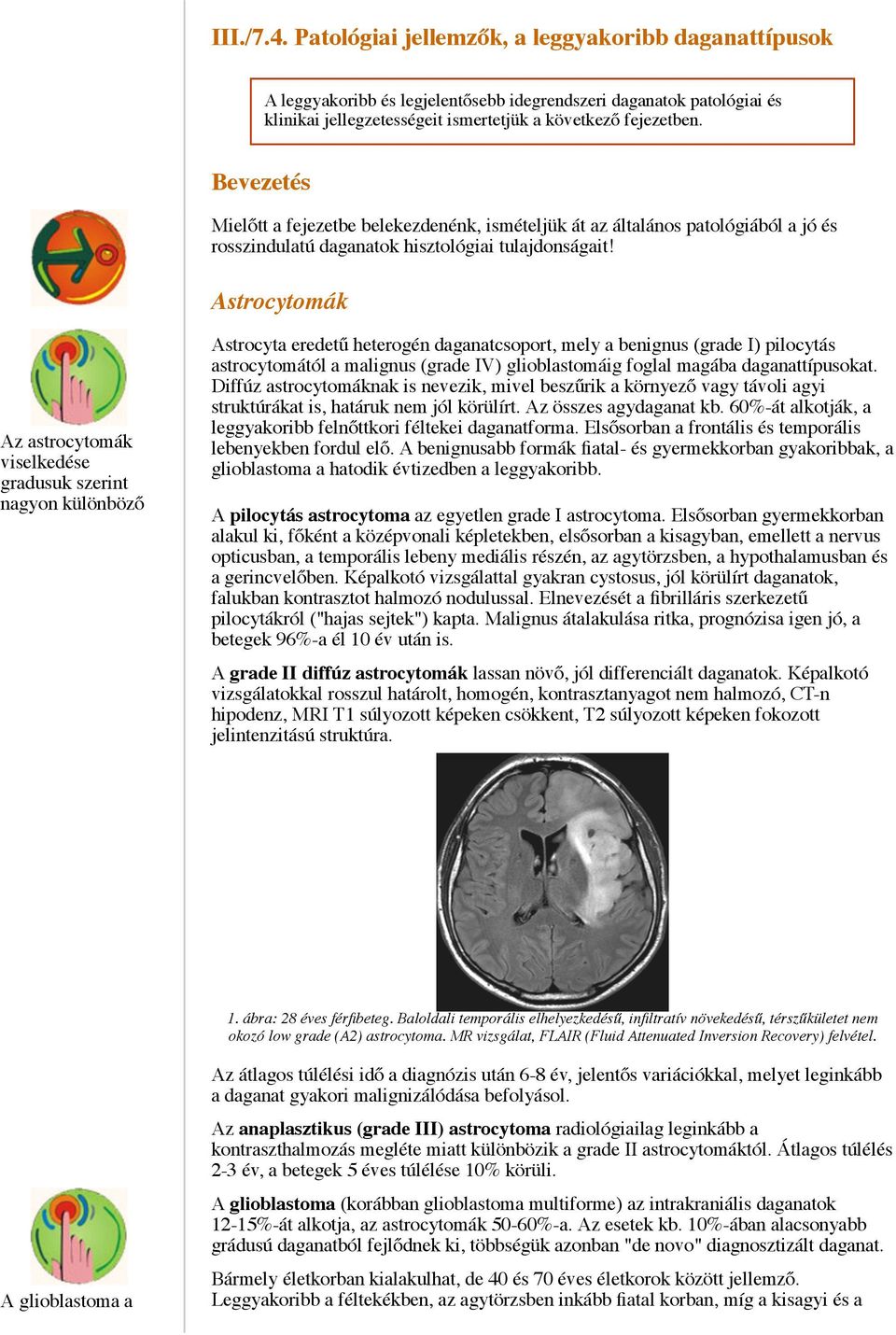 III./7.4. Patológiai jellemzők, a leggyakoribb daganattípusok. Bevezetés.  Astrocytomák - PDF Ingyenes letöltés